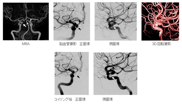 未破裂右内頚動脈瘤