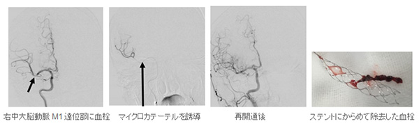 心原性脳塞栓　右中大脳動脈閉塞