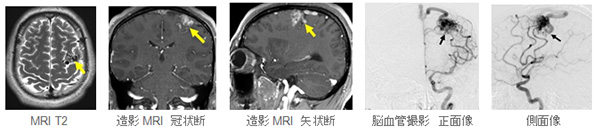 左前頭葉脳動静脈奇形