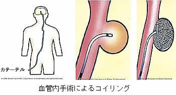 血管内手術によるコイリング