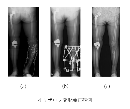 変形矯正症例
