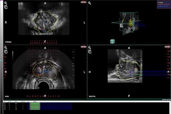 MRI