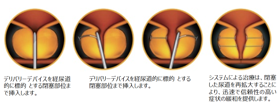 手術詳細