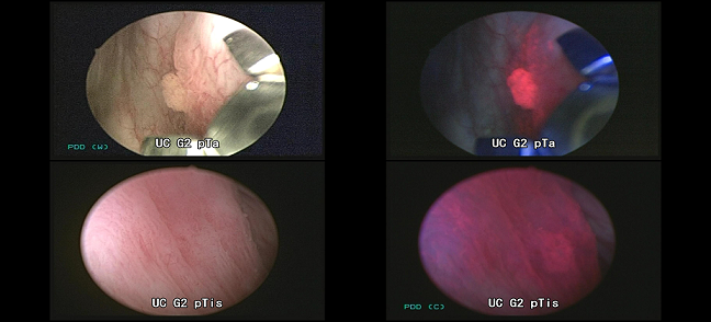 蛍光膀胱鏡1