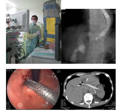 超音波内視鏡下肝内胆管胃吻合術イメージ