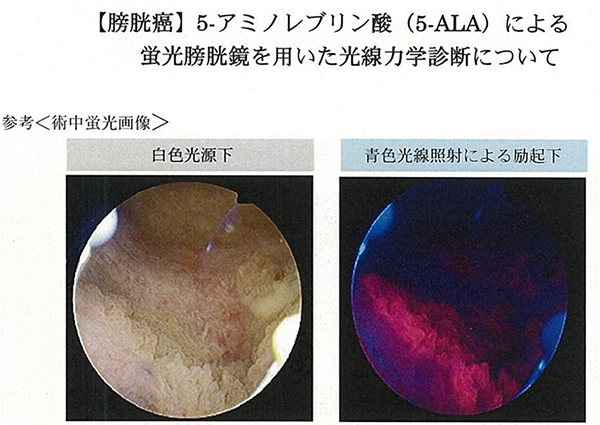 「泌尿器科」光線力学診断について